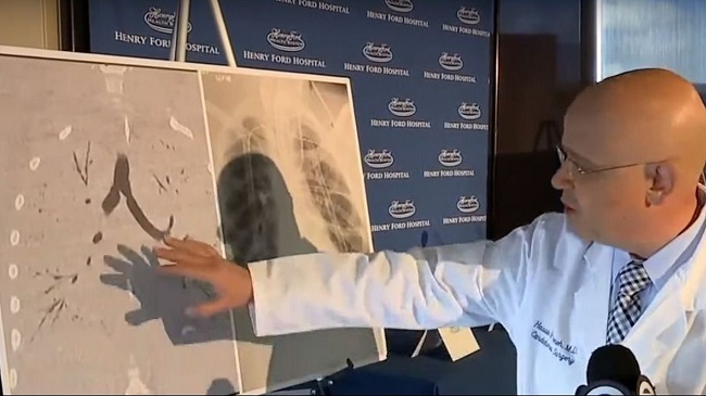 Foto 6 Médico que realizó primer transplante de pulmon por vapeo